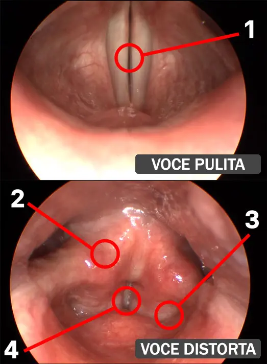 Laringoscopia - Voci distorte